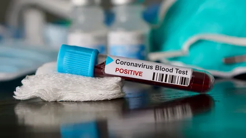 Un italian a murit din cauza Covid-19, după ce a participat la o petrecere organizată special pentru ca oamenii să se infecteze cu noul coronavirus