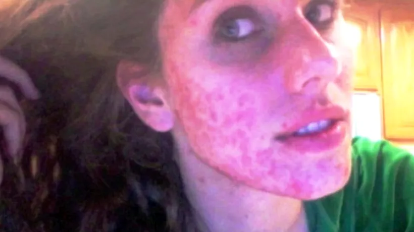 Transformarea incredibilă a unei tinere care s-a luptat ani de zile cu acneea. VIDEO 
