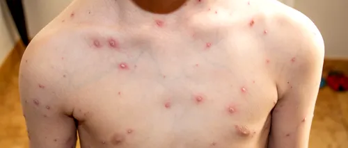 Un nou caz de variola maimuţei a fost diagnosticat în România/ Este al cincilea bărbat depistat cu această boală în ţara noastră