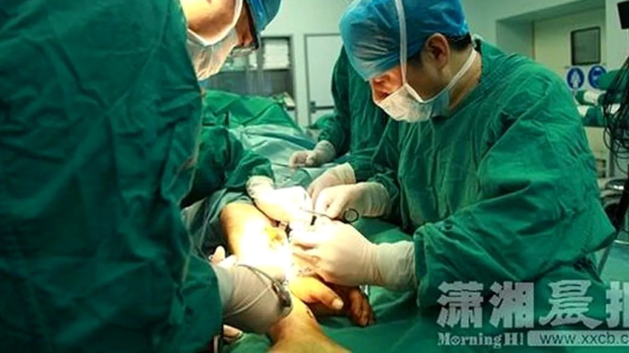 Reușită extraordinară a medicilor chinezi: au salvat mâna unui bărbat, tăiată într-un accident de muncă, „plantând-o