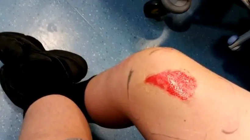 Un copil din Marea Britanie a suferit ARSURI GRAVE, după ce un sos fierbinte cumpărat de la fast-food i-a căzut pe picior