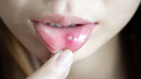 Cât de periculoase sunt, de fapt, aftele. Bolile care se ascund în spatele apariției lor