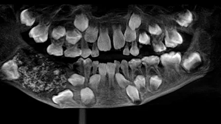 Caz medical neobișnuit. Ce au descoperit doctorii în gura unui băiețel de șapte ani - VIDEO