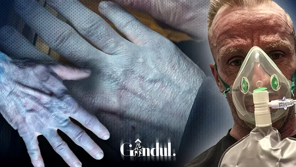 Un bărbat de 42 de ani a ajuns la spital după ce i s-a albăstrit pielea: „Arătam ca personajele din filmul Avatar”. Ce s-a întâmplat de fapt