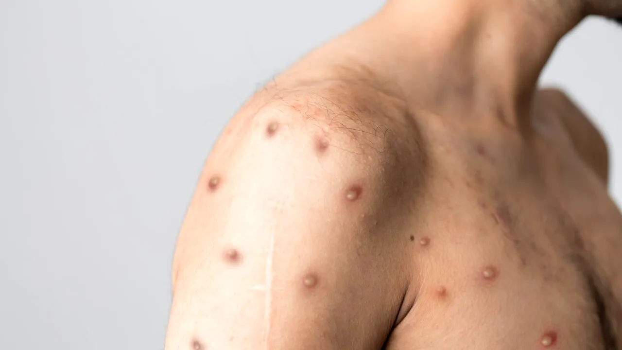 Încă două noi cazuri de variola maimuței, confirmate în România. Numărul îmbolnăvirilor a ajuns la 11