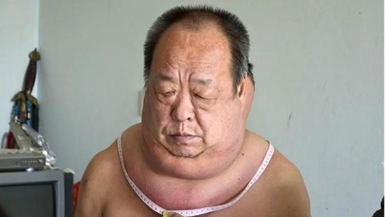 Cum a ajuns un chinez cu o tumoare uriașă în jurul gâtului