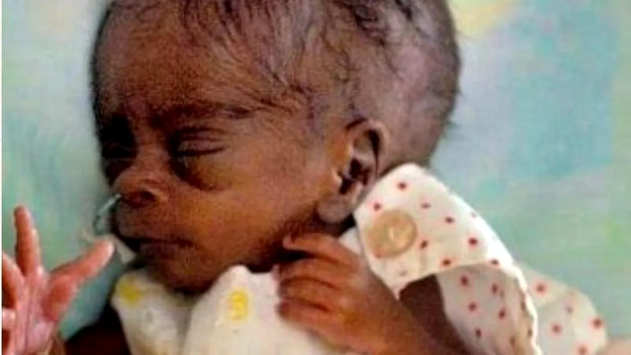 Doctorii i-au dat 1% șanse de supraviețuire la naștere. Cum arată acum fetița care a uimit lumea medicală