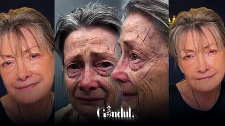 Cum arată o pensionară de 70 de ani după procedura de lifting facial. Internauții l-au numit pe medic „omul-miracol”