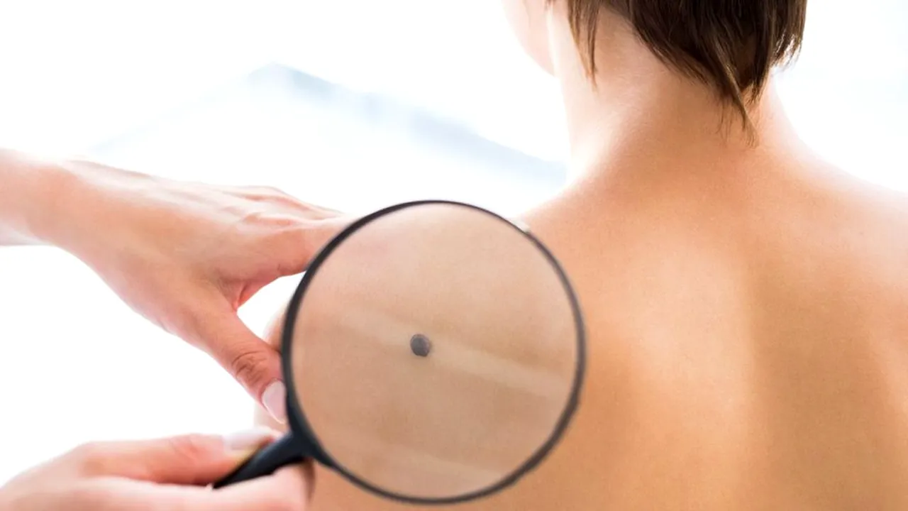 Confundate cu alunițele, excrescențele pielii pot trăda afecțiuni grave