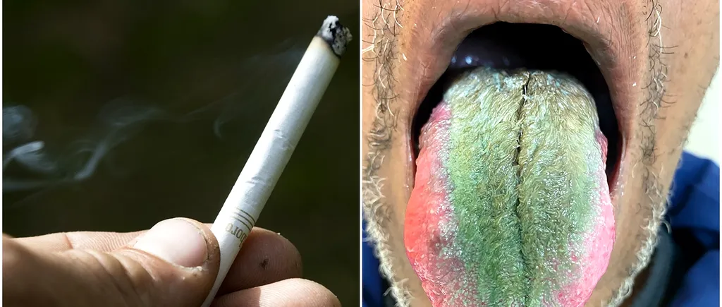 Un fumător s-a trezit cu LIMBA „verde și păroasă”. Cazul lui, trimis direct la Academia Americană de Medicină Orală