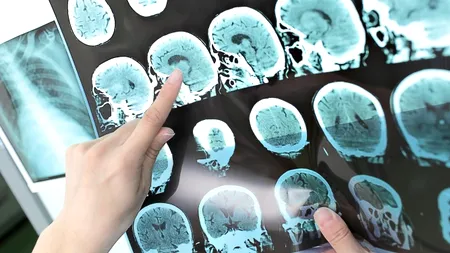 STUDIU. Ce afecțiune gravă îi pândește pe toți pacienții vindecați de COVID-19