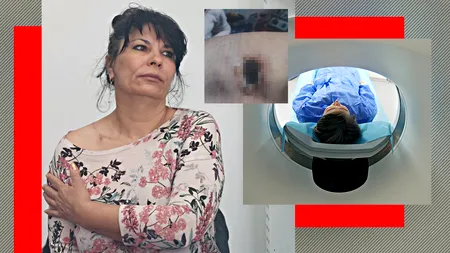 Acuzații GRAVE la adresa unei clinici din Craiova: O pacientă spune că a suferit o arsură de gradul III în timp ce făcea un RMN