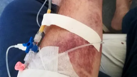 Coșmarul unui pacient cu COVID-19, internat la Terapie Intensivă: „Mănânci lângă mort și te bucuri că nu ești tu”