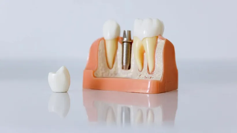 (P) Află aici informații despre implantul dentar obținut în doar 24 de ore