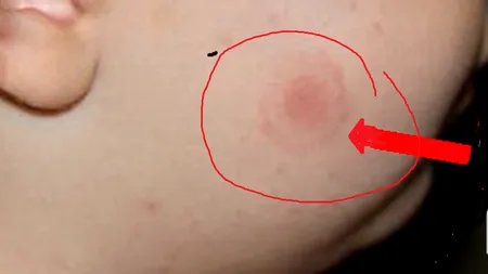 Zeci de bucureșteni ajung la medic din cauza mușcăturilor de căpușe. Cum să te ferești de bolile grave transmise de căpușă