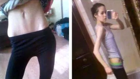 Transformare incredibilă în numai un an de zile a acestei tinere care cântărea doar 35 de kilograme