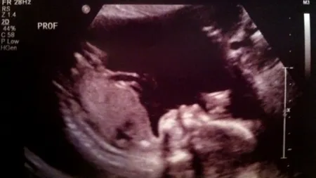 Ce surpriză a avut o gravidă când a făcut ecografie