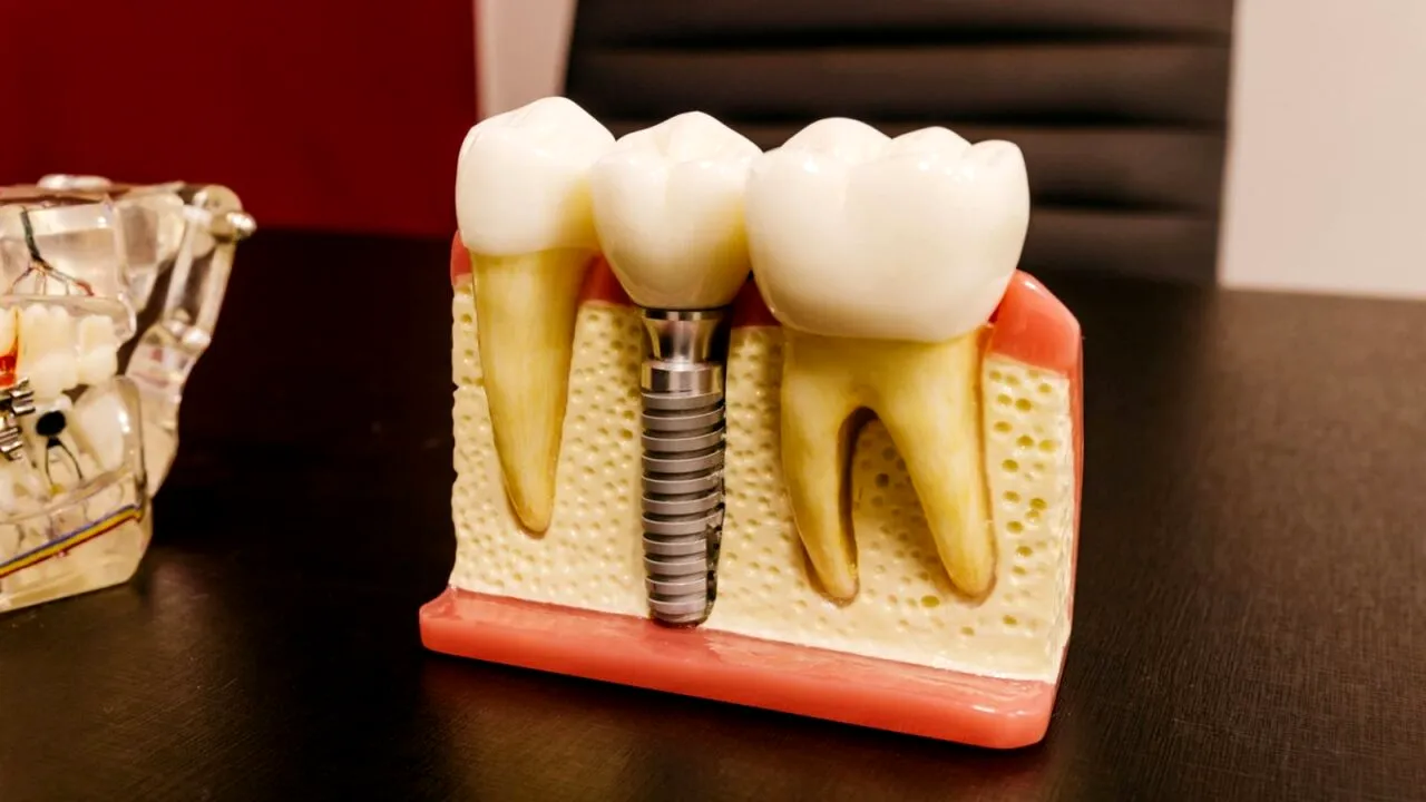 (P) Se poate face implantul dentar în etape, plătite pe parcurs?