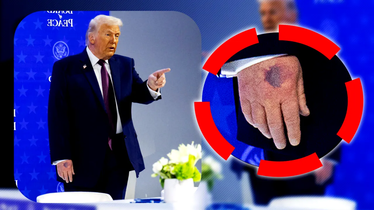 Trump a dat cu pumnul în masă la propriu. Casa Albă precizează că președintele și-a învinețit mâna când s-a lovit de masă la Consiliul pentru Pace