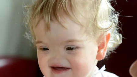 Medicii nu i-au dat nicio șansă. Povestea impresionantă a fetiței care s-a născut fără nas: „Pentru noi, este perfectă