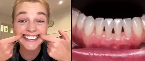 VIDEO | Ce înseamnă, de fapt, dacă ai „triunghiuri negre” între dinți / Un expert stomatolog explică ce anume le cauzează și cum trebuie îngrijite