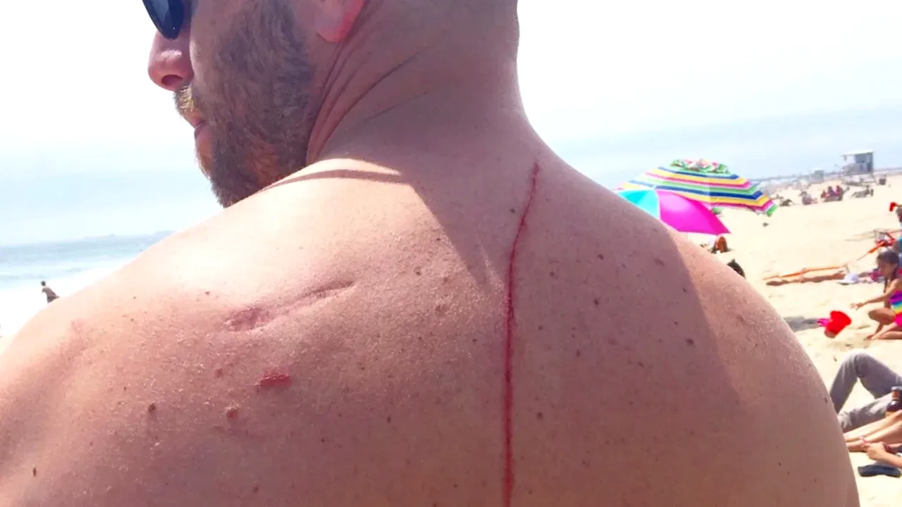 Trauma care i-a salvat viața. Un bărbat a aflat că are tumoră la rinichi după ce a fost mușcat de rechin