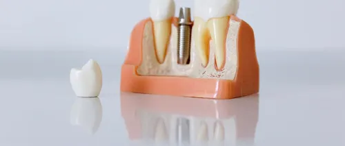 (P) Află aici informații despre implantul dentar obținut în doar 24 de ore