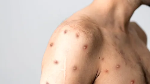 România a primit peste 5.000 de doze de vaccin împotriva variolei maimuţei, informează Ministerul Sănătății