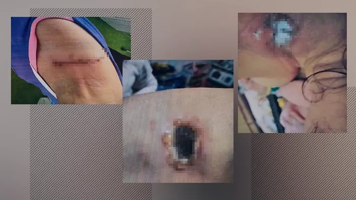 O pacientă spune că a suferit o arsură de gradul III în timp ce făcea un RMN