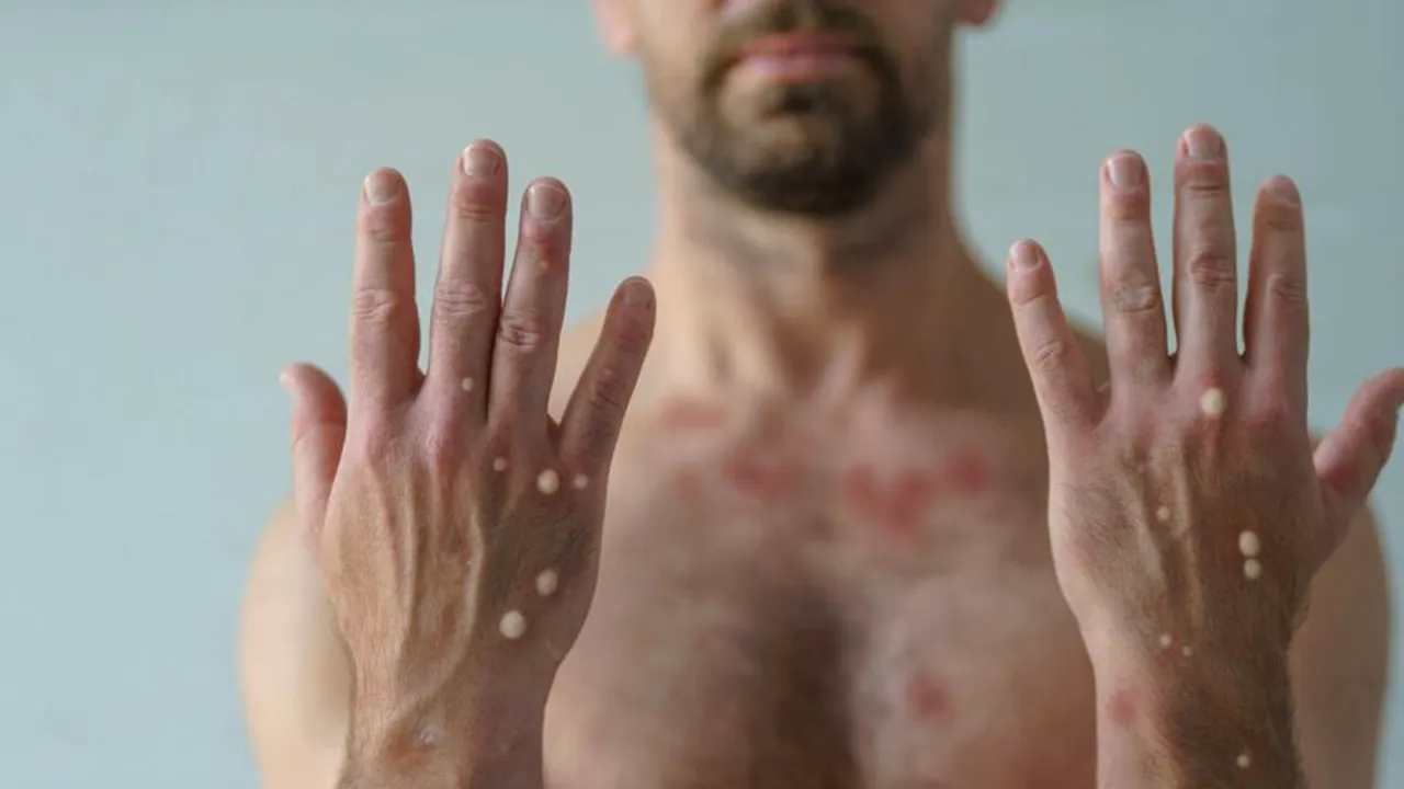 Ministerul Sănătății anunță două noi cazuri de variola maimuței în România