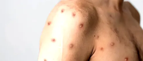 Simptomele primelor cazuri europene de variola maimuței diferă de cazurile africane