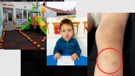 Acuzații TERIFIANTE la adresa unei educatoare de la o creșă din Constanța. ”Băiatul era plin de vânătăi și avea urme de unghii de femeie în mânuță”