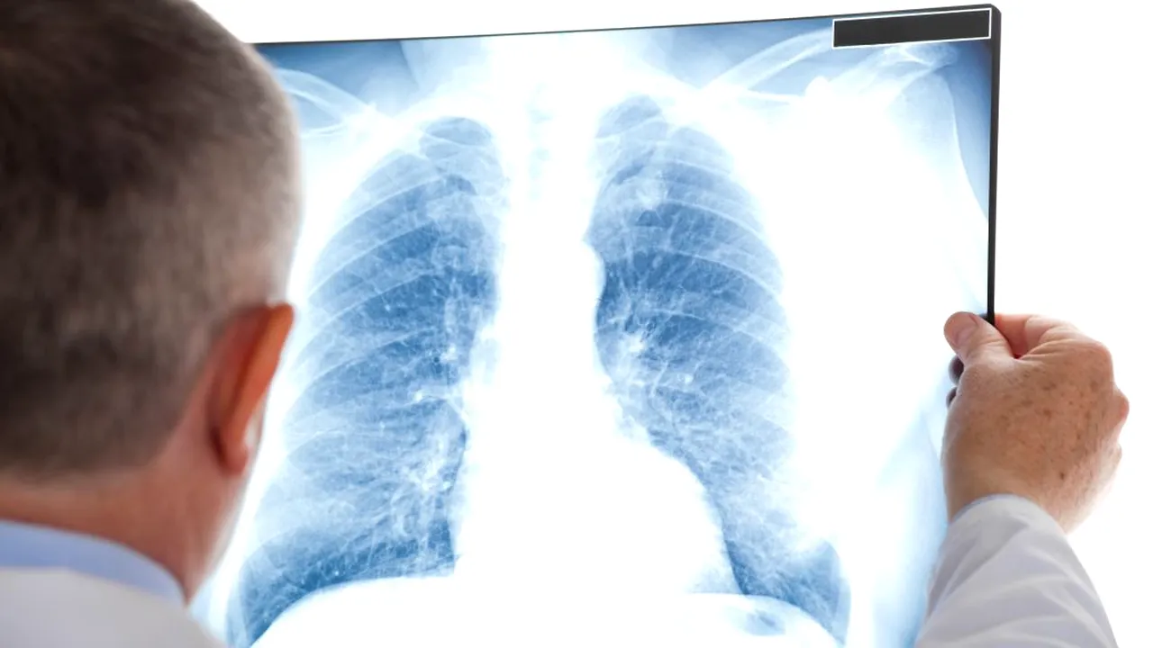 Ce a pățit o femeie, bolnavă de TBC, după ce a refuzat tratamentul împotriva tuberculozei