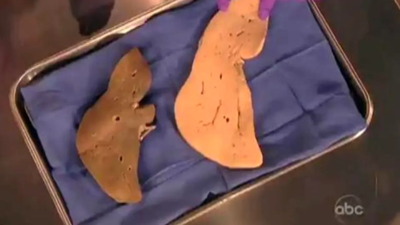 VIDEO. Cum arată inima și ficatul unei persoane obeze