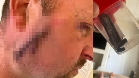 Caz de malpraxis în Satu Mare. Un bărbat acuză medicii că a fost cusut cu o bucată de lemn rămasă înfiptă în obraz