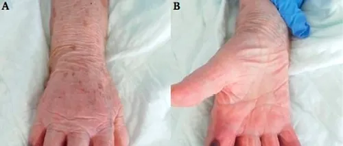 Imagini șocante: Medicii au amputat trei degete unei paciente cu COVID-19, după ce i s-au înnegrit