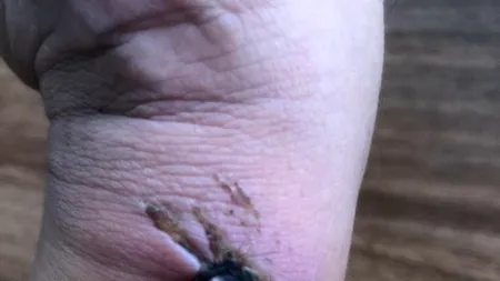 Caz șocant în Bistrița. Medicii sunt acuzați că au cusut o rană ca la „abator