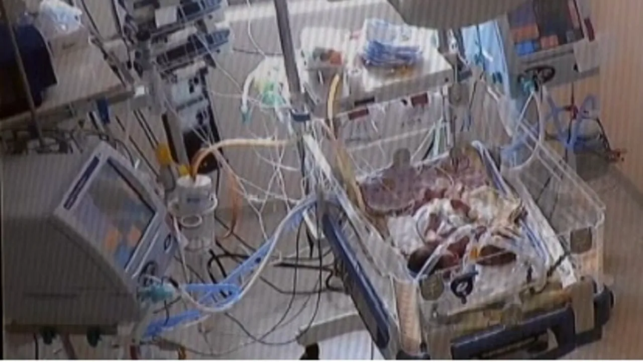 Medicii nu știu ce să facă pentru siamezele născute înainte de Crăciun. De ce este cazul unic în lume