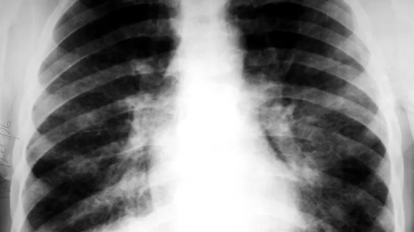 Neoplasm pulmonar, boala anului 2023. Avertismentul medicilor: nu doare, dar este fatală! Semnele care trebuie să te îngrijoreze