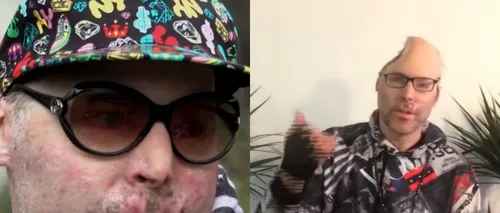 VIDEO | Rapper mutilat în timp ce prepara ulei de canabis. Niko a rămas fără jumătate din craniu, în urma unei explozii: „Am făcut o greșeală uriașă”