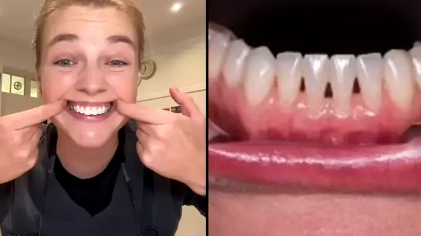 VIDEO | Ce înseamnă, de fapt, dacă ai „triunghiuri negre” între dinți / Un expert stomatolog explică ce anume le cauzează și cum trebuie îngrijite