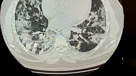 Un medic de la noi a publicat imagini de groază cu plămânii unui pacient cu COVID: „Cum facem cu ei domnule doctor Bittman?”