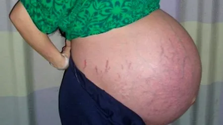 Premieră în Cehia: nașterea a cinci gemeni concepuți natural