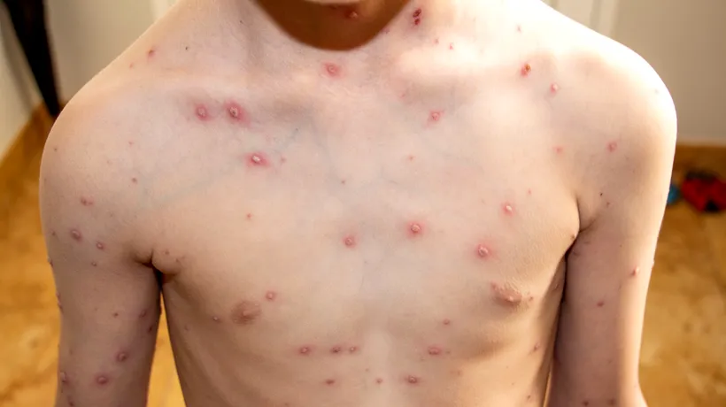 Un nou caz de variola maimuţei a fost diagnosticat în România/ Este al cincilea bărbat depistat cu această boală în ţara noastră