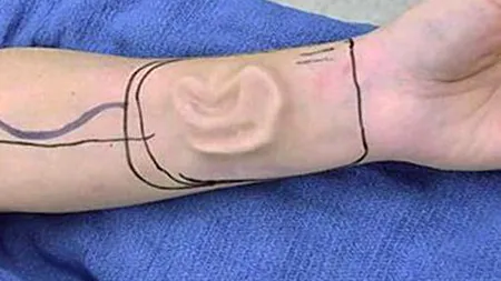 Soluție inedită a medicilor pentru a-i reda urechea unei paciente bolnave de cancer. GALERIE FOTO