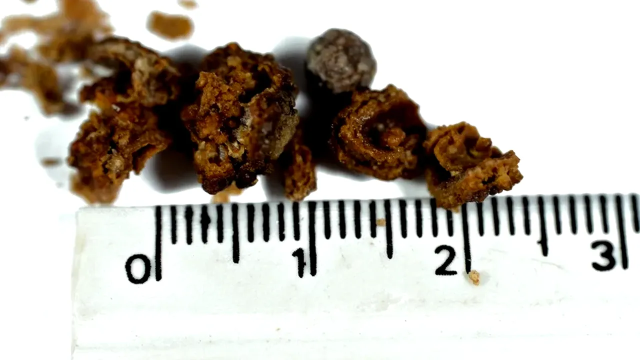 Cum să elimini pietrele la rinichi FĂRĂ PASTILE și fără să te doară