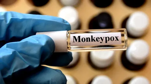 Ungaria a raportat primul caz de variola maimuței