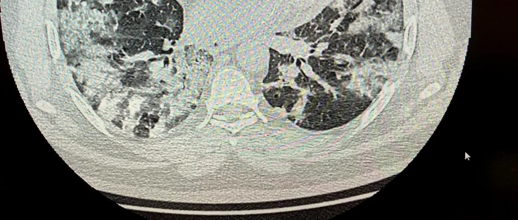 Un medic de la noi a publicat imagini de groază cu plămânii unui pacient cu COVID: „Cum facem cu ei domnule doctor Bittman?”