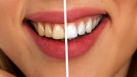 Planta care ALBEȘTE dinții galbeni și te scapă de durerile gingivale