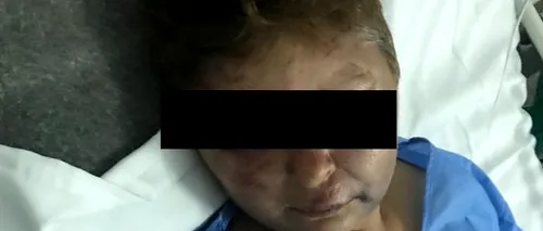Polițist acuzat că a desfigurat o femeie în județul Olt. Victima: „A vrut relații cu mine... Mi-a dat cu picioarele, cu vătraiul